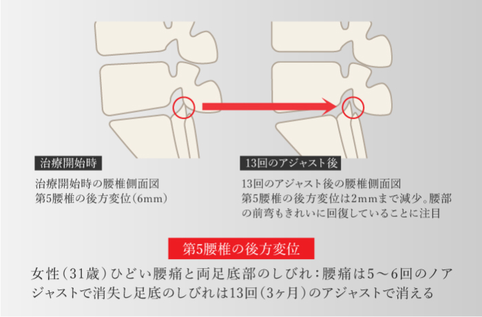 第5頸椎の後方変位