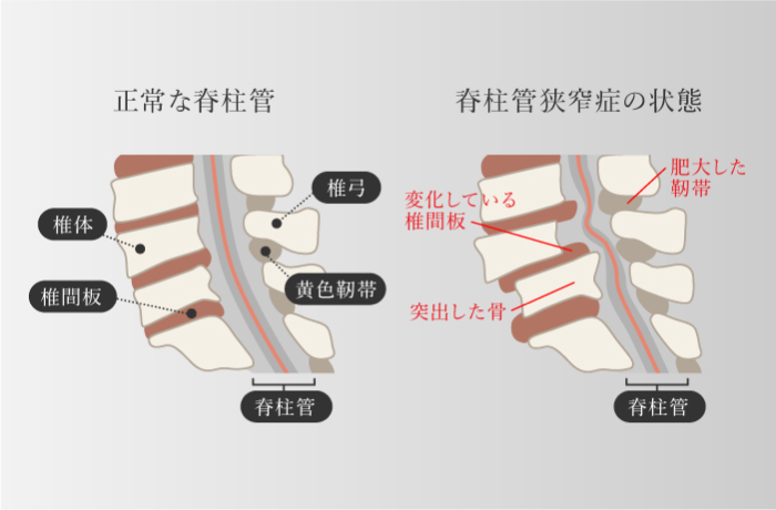 脊柱管狭窄症の状態