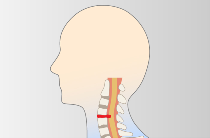 頸部椎間板症